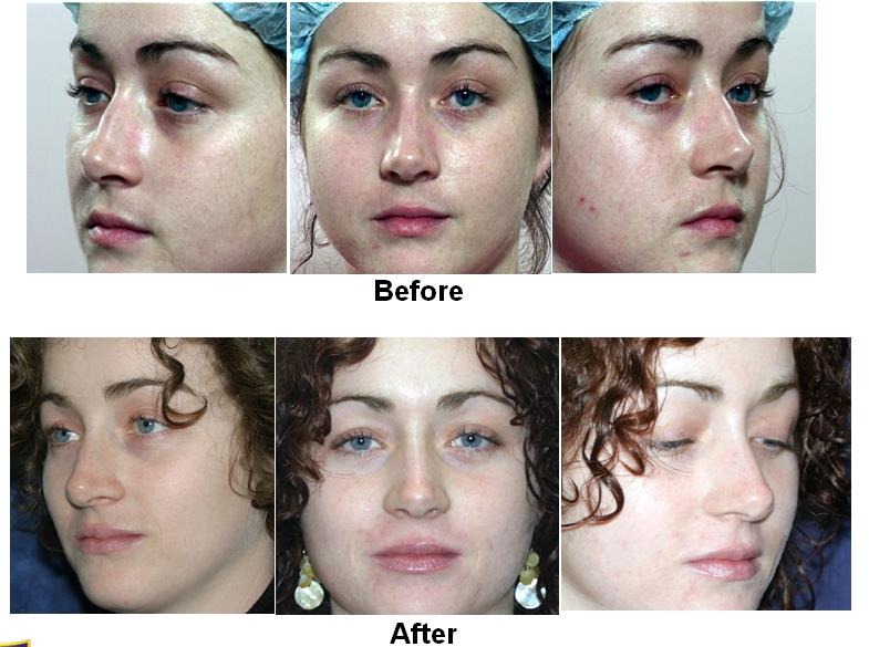 nose reconstruction quotes lowell ma